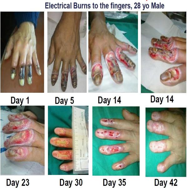 42 days of treatment with pcell wound (topical)