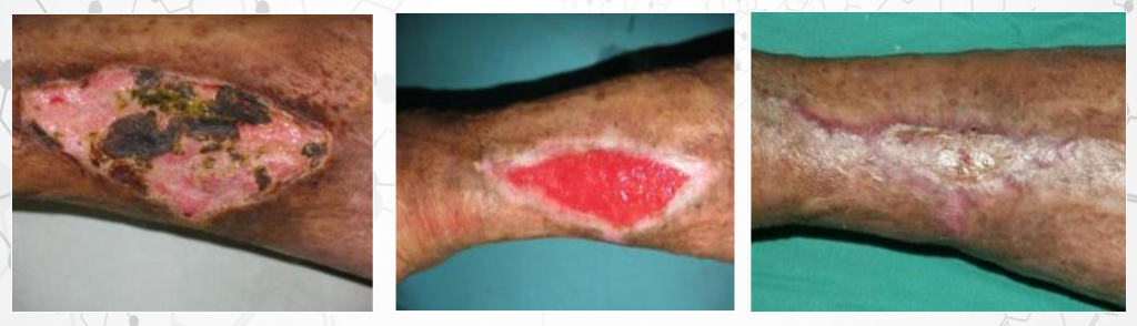 diabetic wound